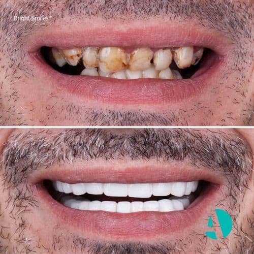 Lamine Diş Kaplama Tedavisi Öncesi Sonrası, fiyatları Antalya