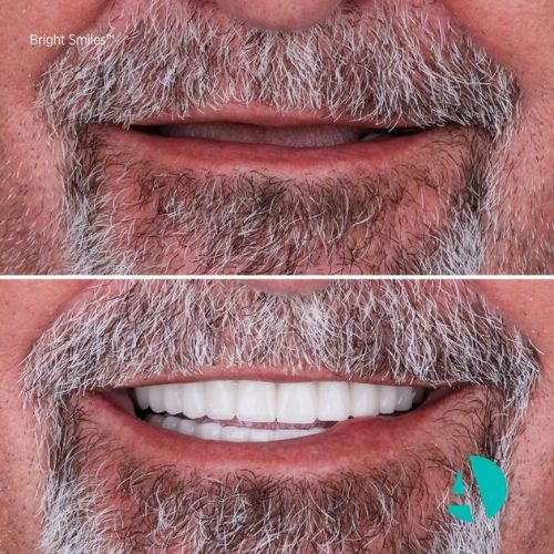 vor und nach dem All-on-6-Zahnimplantat